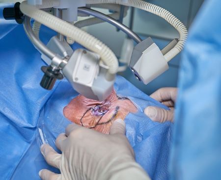 Staaroperatie: een ingreep waarbij de arts een vertroebelde lens vervangt door een kunstlens 